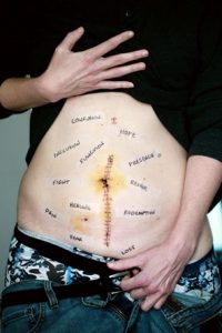 Woman exposing her chronic illness and pain on her stomach, showing scars, Shame and Chronic illness blog, begin therapy today in katy texas, counseling center at cinco ranch.